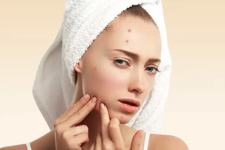 Acne medzsupplier