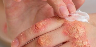 Scabies