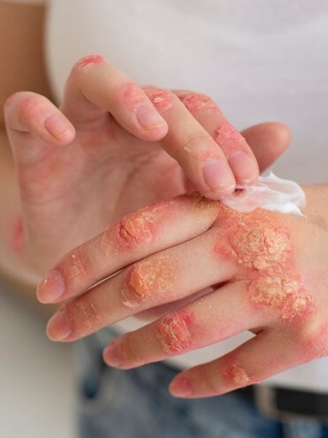 Does ivermectin work for scabies?
