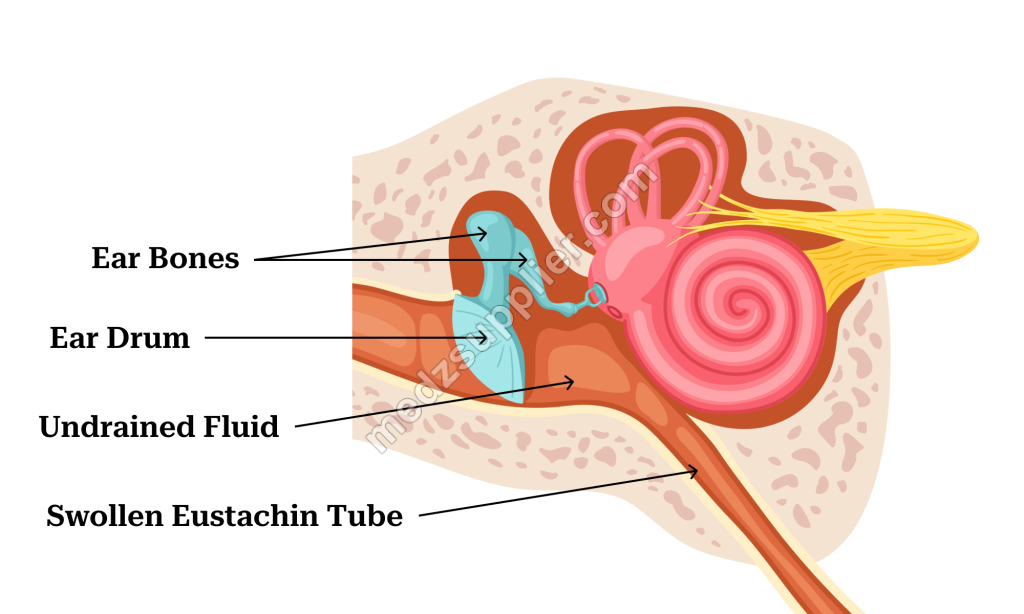 Inner Ear infections 1 medzsupplier